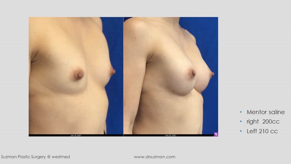 Dr. Suzman: ssaline breast imp